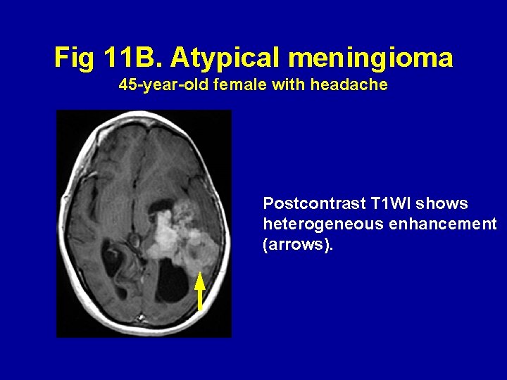 Fig 11 B. Atypical meningioma 45 -year-old female with headache Postcontrast T 1 WI