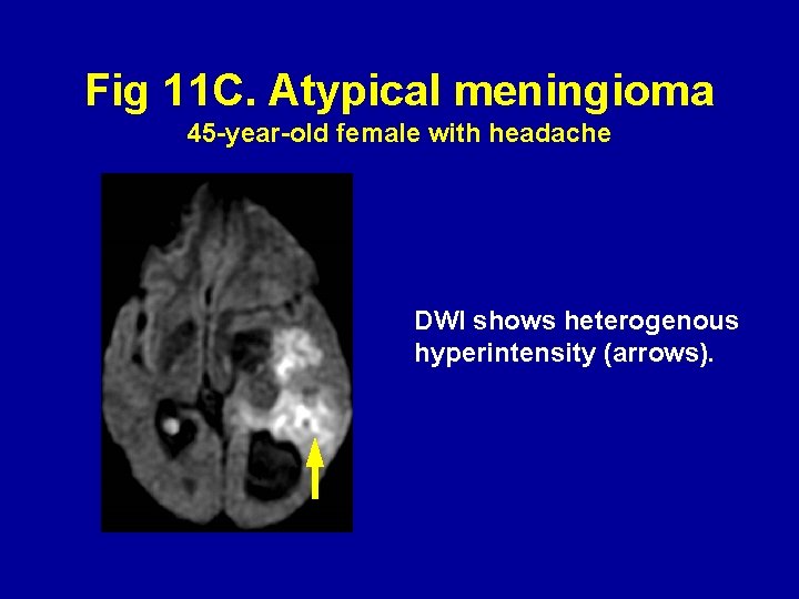 Fig 11 C. Atypical meningioma 45 -year-old female with headache DWI shows heterogenous hyperintensity
