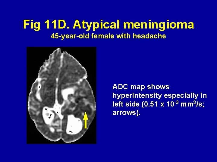 Fig 11 D. Atypical meningioma 45 -year-old female with headache ADC map shows hyperintensity