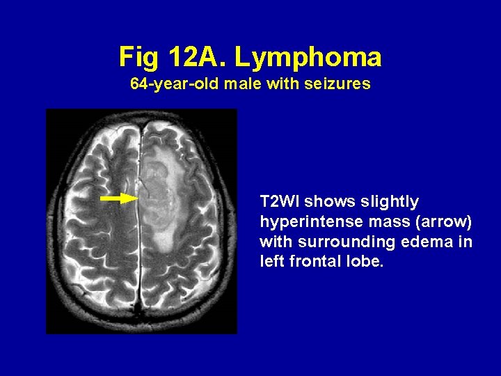 Fig 12 A. Lymphoma 64 -year-old male with seizures T 2 WI shows slightly