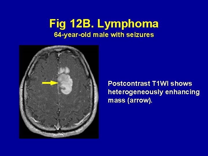 Fig 12 B. Lymphoma 64 -year-old male with seizures Postcontrast T 1 WI shows