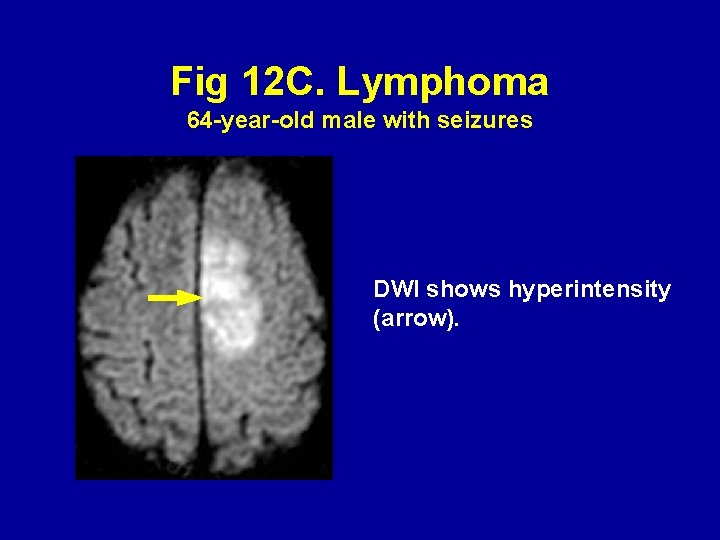 Fig 12 C. Lymphoma 64 -year-old male with seizures DWI shows hyperintensity (arrow). 