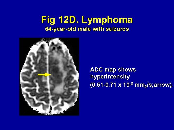 Fig 12 D. Lymphoma 64 -year-old male with seizures ADC map shows hyperintensity (0.