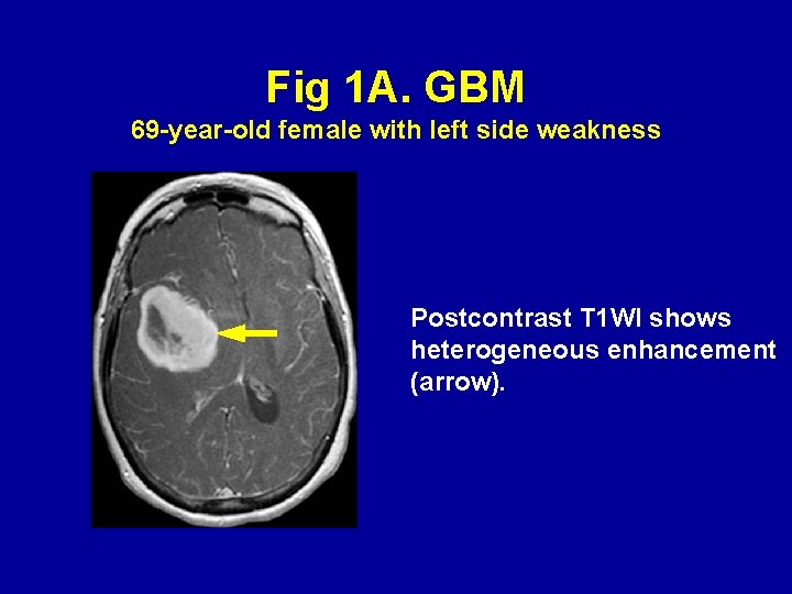 Fig 1 A. GBM 69 -year-old female with left side weakness Postcontrast T 1