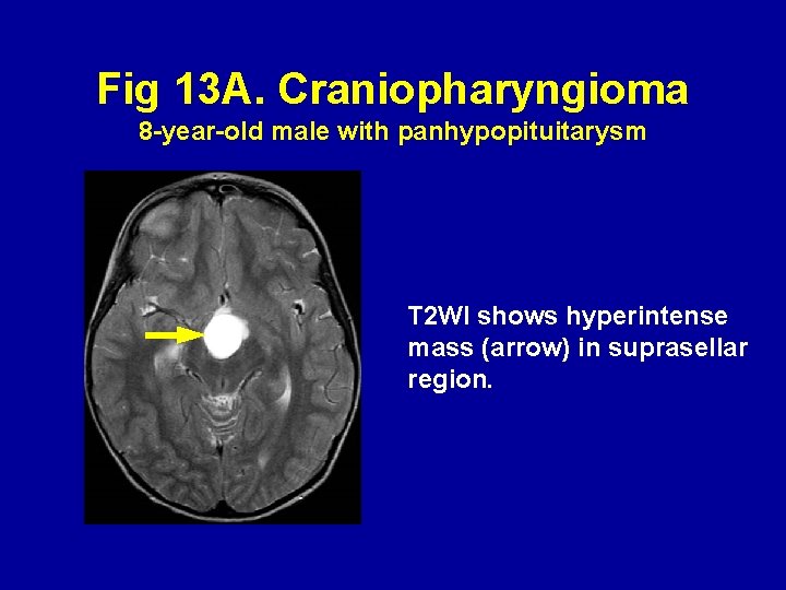 Fig 13 A. Craniopharyngioma 8 -year-old male with panhypopituitarysm T 2 WI shows hyperintense