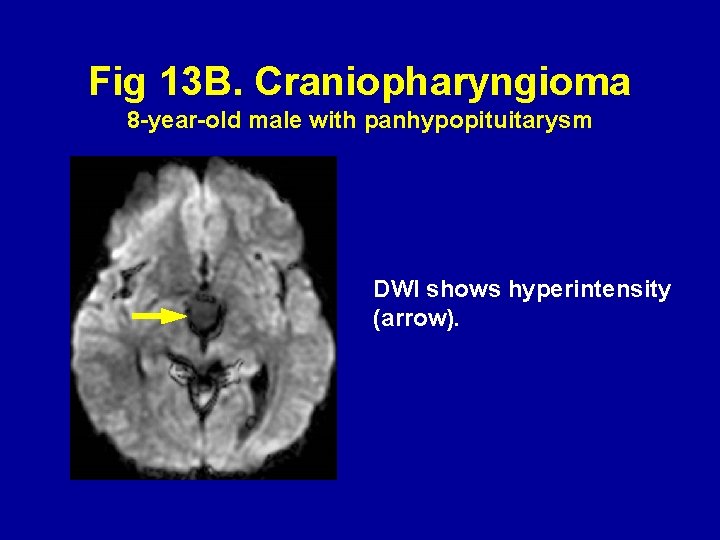 Fig 13 B. Craniopharyngioma 8 -year-old male with panhypopituitarysm DWI shows hyperintensity (arrow). 