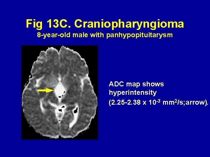 Fig 13 C. Craniopharyngioma 8 -year-old male with panhypopituitarysm ADC map shows hyperintensity (2.