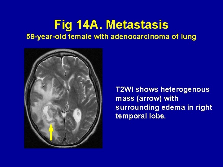 Fig 14 A. Metastasis 59 -year-old female with adenocarcinoma of lung T 2 WI