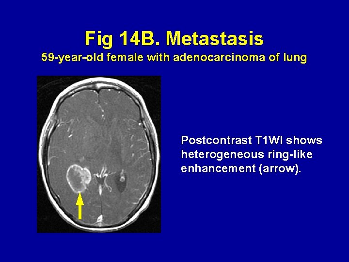 Fig 14 B. Metastasis 59 -year-old female with adenocarcinoma of lung Postcontrast T 1