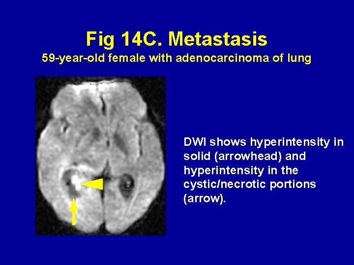 Fig 14 C. Metastasis 59 -year-old female with adenocarcinoma of lung DWI shows hyperintensity