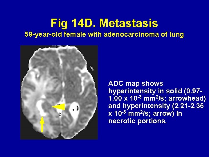 Fig 14 D. Metastasis 59 -year-old female with adenocarcinoma of lung ADC map shows