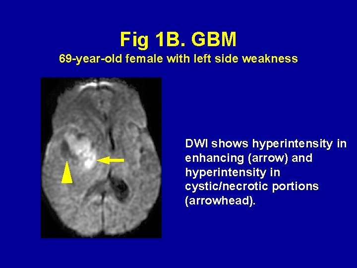 Fig 1 B. GBM 69 -year-old female with left side weakness DWI shows hyperintensity