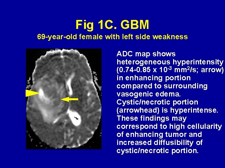 Fig 1 C. GBM 69 -year-old female with left side weakness ADC map shows