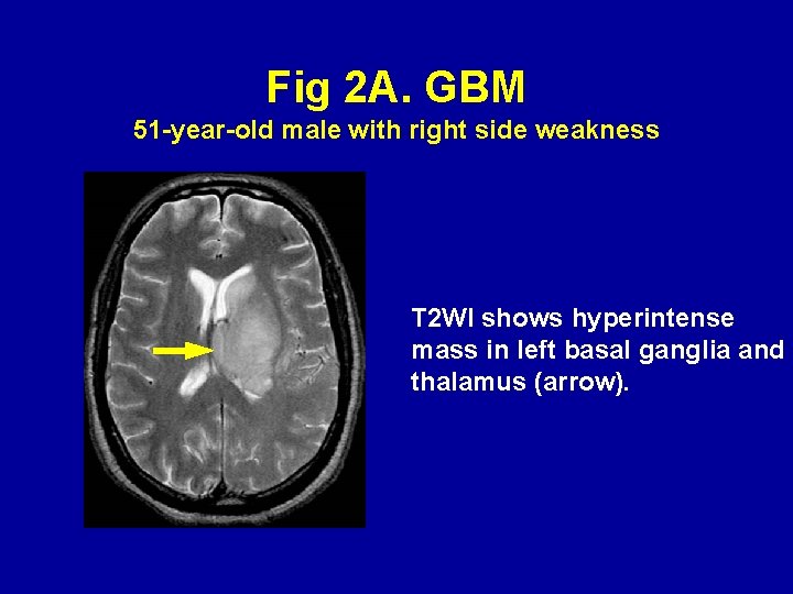 Fig 2 A. GBM 51 -year-old male with right side weakness T 2 WI