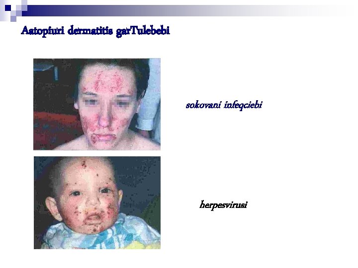 Aatopiuri dermatitis gar. Tulebebi sokovani infeqciebi herpesvirusi 