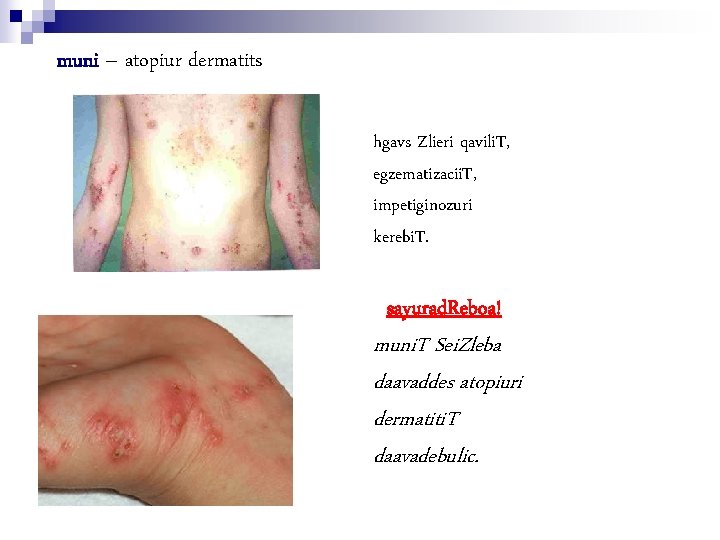 muni – atopiur dermatits hgavs Zlieri qavili. T, egzematizacii. T, impetiginozuri kerebi. T. sayurad.