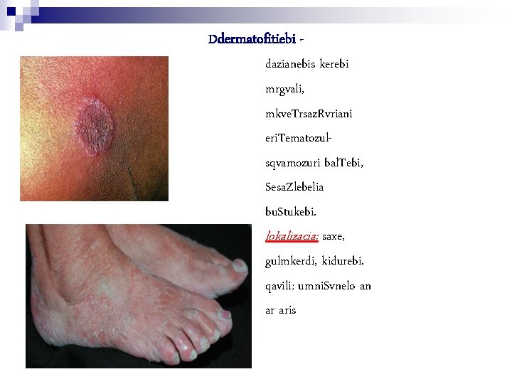 Ddermatofitiebi dazianebis kerebi mrgvali, mkve. Trsaz. Rvriani eri. Tematozulsqvamozuri bal. Tebi, Sesa. Zlebelia bu.