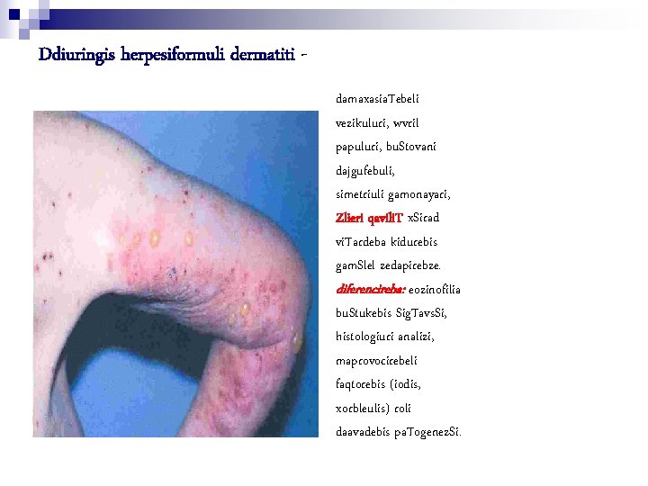 Ddiuringis herpesiformuli dermatiti damaxasia. Tebeli vezikuluri, wvril papuluri, bu. Stovani dajgufebuli, simetriuli gamonayari, Zlieri