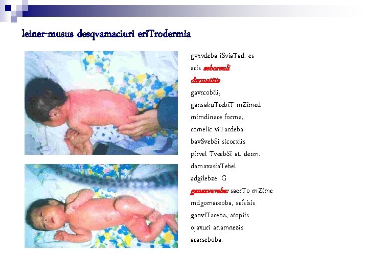 leiner-musus desqvamaciuri eri. Trodermia gvxvdeba i. Svia. Tad. es aris seboreuli dermatitis gavrcobili, gansaku.