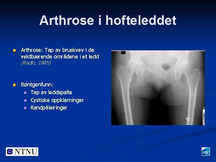 Arthrose i hofteleddet n Arthrose: Tap av bruskvev i de vektbærende områdene i et