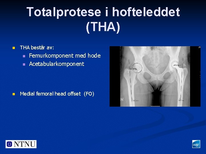 Totalprotese i hofteleddet (THA) n THA består av: n n n Femurkomponent med hode