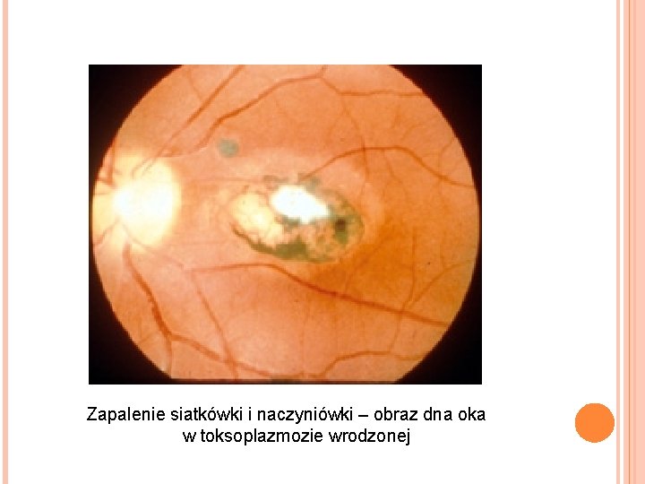 Zapalenie siatkówki i naczyniówki – obraz dna oka w toksoplazmozie wrodzonej 