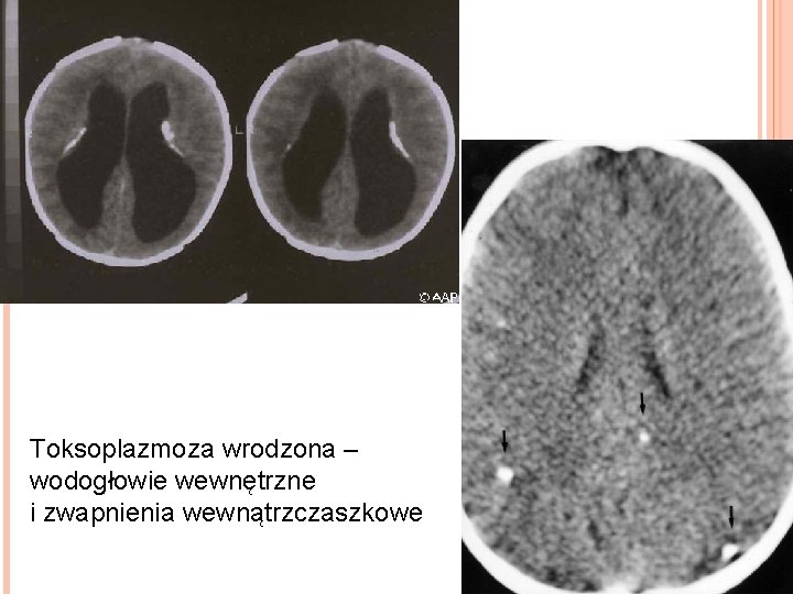 Toksoplazmoza wrodzona – wodogłowie wewnętrzne i zwapnienia wewnątrzczaszkowe 