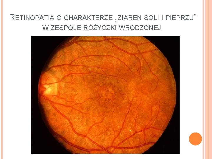 RETINOPATIA O CHARAKTERZE „ZIAREN SOLI I PIEPRZU” W ZESPOLE RÓŻYCZKI WRODZONEJ 