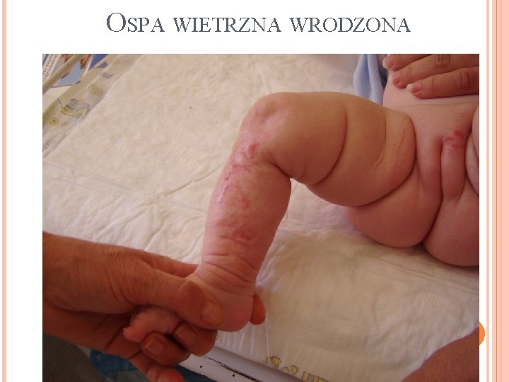 OSPA WIETRZNA WRODZONA 