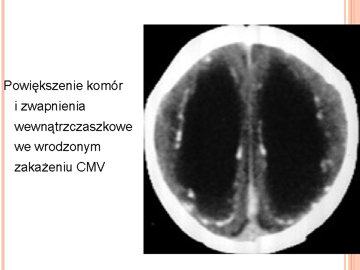 Powiększenie komór i zwapnienia wewnątrzczaszkowe we wrodzonym zakażeniu CMV 