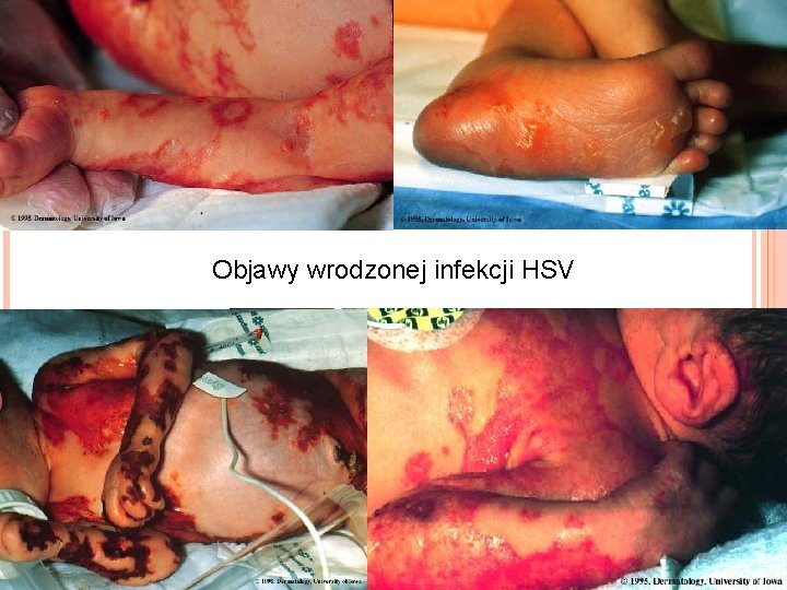 Objawy wrodzonej infekcji HSV 