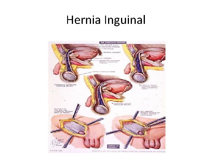 Hernia Inguinal 