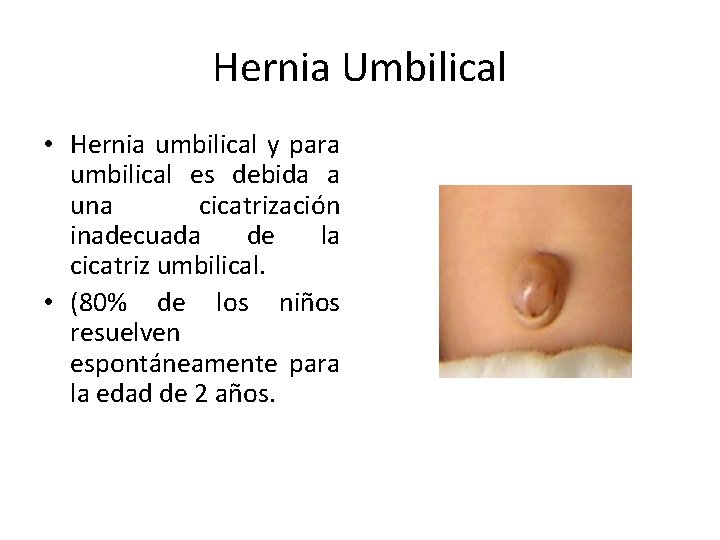 Hernia Umbilical • Hernia umbilical y para umbilical es debida a una cicatrización inadecuada