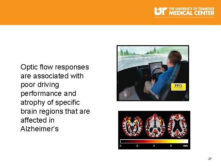 Optic flow responses are associated with poor driving performance and atrophy of specific brain