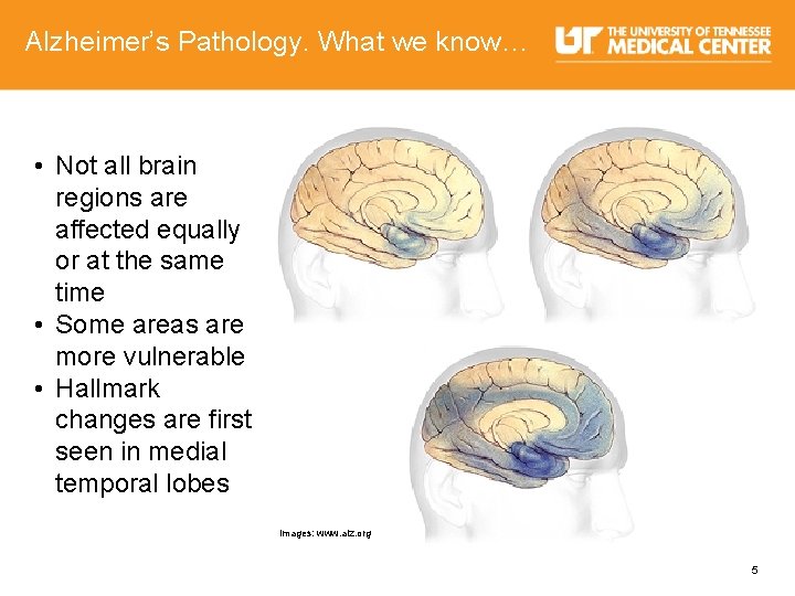 Alzheimer’s Pathology. What we know… • Not all brain regions are affected equally or
