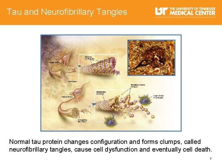 Tau and Neurofibrillary Tangles Normal tau protein changes configuration and forms clumps, called neurofibrillary