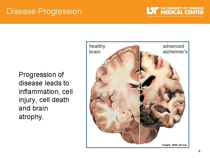 Disease Progression of disease leads to inflammation, cell injury, cell death and brain atrophy.