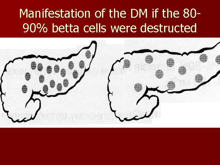 Manifestation of the DM if the 8090% betta cells were destructed 