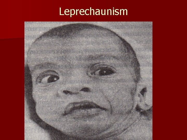 Leprechaunism 