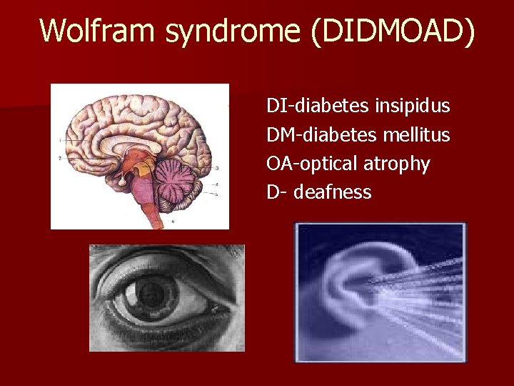 Wolfram syndrome (DIDMOAD) DI-diabetes insipidus DM-diabetes mellitus OA-optical atrophy D- deafness 