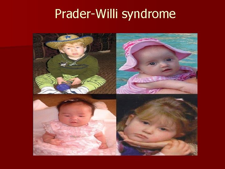 Prader-Willi syndrome 