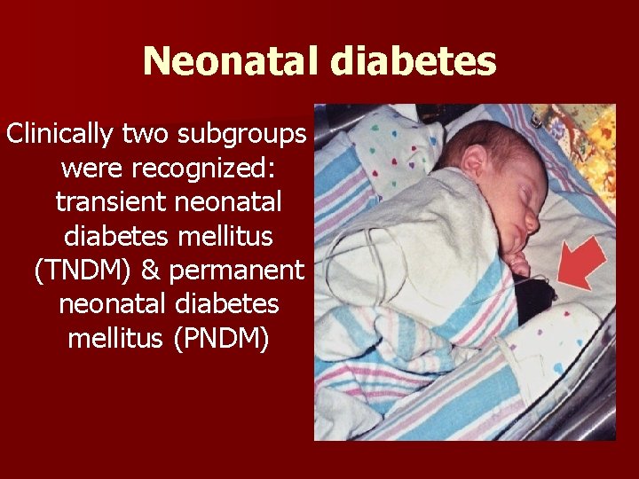 Neonatal diabetes Clinically two subgroups were recognized: transient neonatal diabetes mellitus (TNDM) & permanent