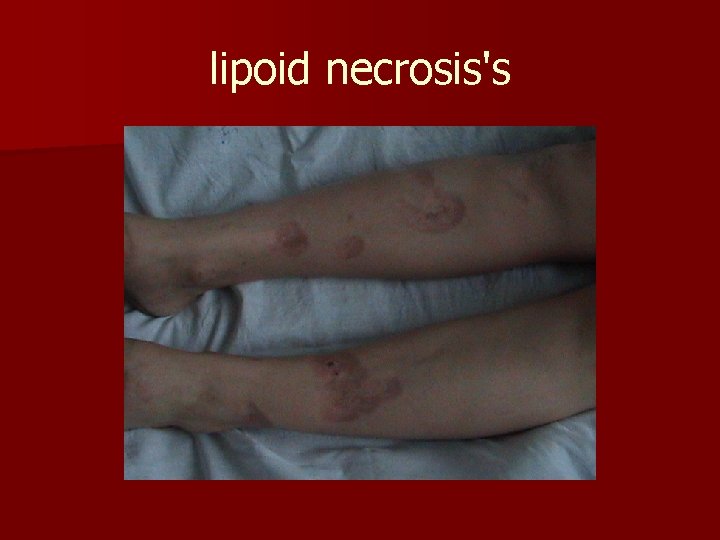 lipoid necrosis's 