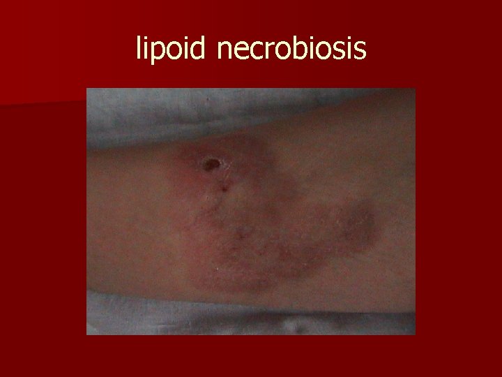 lipoid necrobiosis 