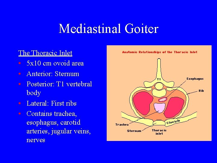 Mediastinal Goiter The Thoracic Inlet • 5 x 10 cm ovoid area • Anterior: