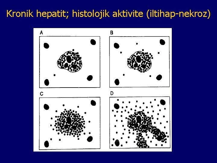 Kronik hepatit; histolojik aktivite (iltihap-nekroz) 