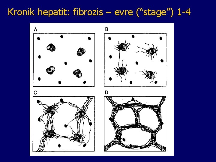 Kronik hepatit: fibrozis – evre (“stage”) 1 -4 