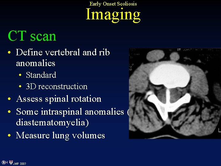 Early Onset Scoliosis Imaging CT scan • Define vertebral and rib anomalies • Standard