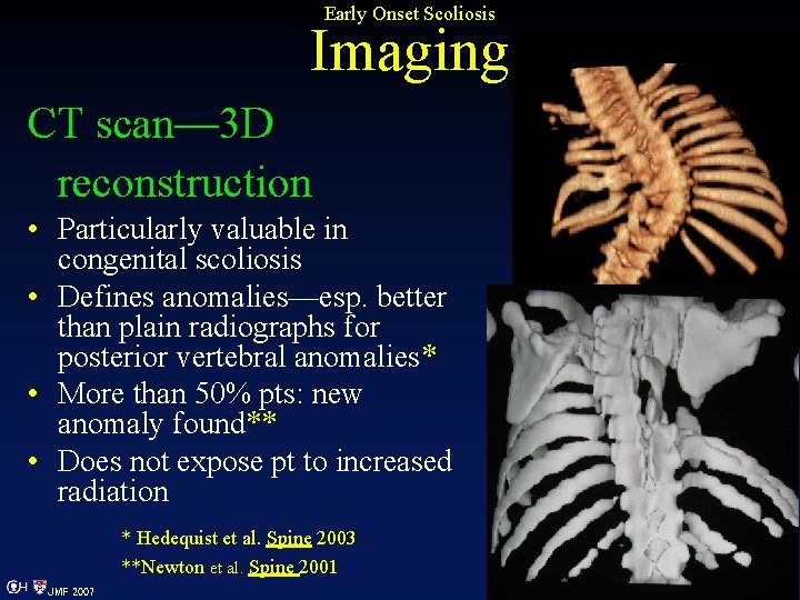 Early Onset Scoliosis Imaging CT scan— 3 D reconstruction • Particularly valuable in congenital