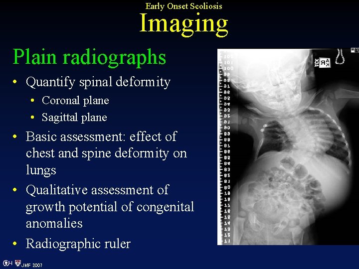 Early Onset Scoliosis Imaging Plain radiographs • Quantify spinal deformity • Coronal plane •